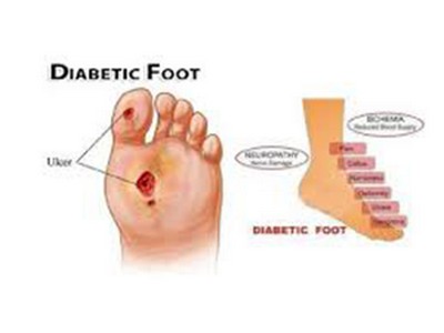 Diabetic-Foot-Surgery