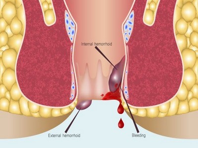 Piles-surgery-inner-1