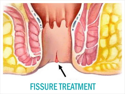 fissuretreatment-1 (1)