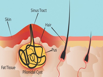 what-is-a-pilondial-cyst-1440x810