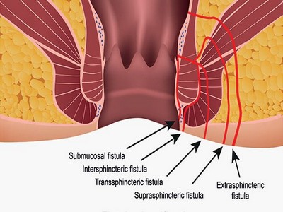 what-you-should-know-about-fistulas-722x406